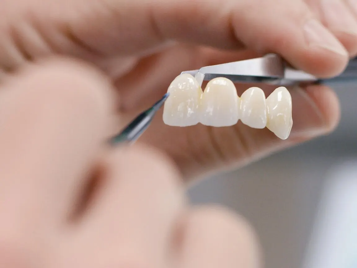 Trois facettes en disilicate de lithium — de fines coques de porcelaine translucide, la lumière traversant leurs bords.